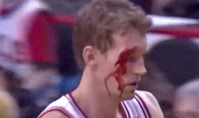 Mike-Dunleavy-elbow-blood