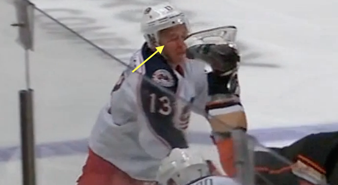 Cam Atkinson Gets Cut After Taking Ryan Kelser's Skate To Face